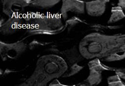 Alcoholic liver disease Powerpoint Presentation