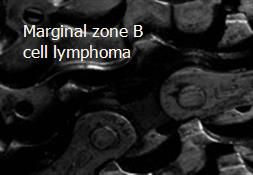 Marginal zone B-cell lymphoma Powerpoint Presentation