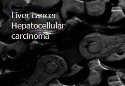 Liver cancer Hepatocellular carcinoma Powerpoint Presentation