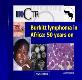 African burkitts lymphoma Powerpoint Presentation