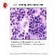 Hodgkin lymphoma Powerpoint Presentation