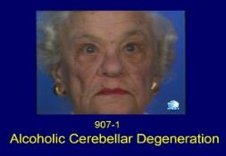 Alcoholic Cerebellar Degeneration PowerPoint Presentation