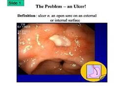 Bacteria Helicobacter Pylori Ulcers PowerPoint Presentation