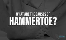 What are the Causes of Hammertoe? PowerPoint Presentation