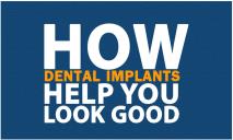 How dental implants help you look good PowerPoint Presentation