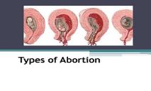 Types of Abortion PowerPoint Presentation