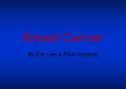 Information of Breast Cancer Powerpoint Presentation