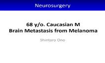 Brain Metastasis from Melanoma PowerPoint Presentation