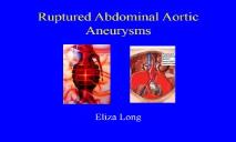 An Abdominal Aortic Aneurysms PowerPoint Presentation