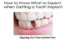 How to Know What to Expect when Getting a Tooth Implant PowerPoint Presentation