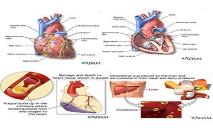 Coronary Heart Disease PowerPoint Presentation