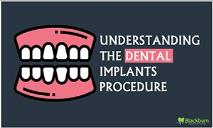 Understanding The Dental Implants Procedure PowerPoint Presentation