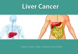 About Liver Cancer Powerpoint Presentation