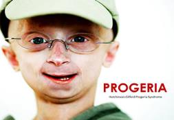 Progeria (Aging Disease) Powerpoint Presentation