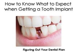 How to Know What to Expect when Getting a Tooth Implant Powerpoint Presentation