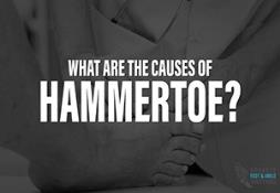 What are the Causes of Hammertoe? Powerpoint Presentation