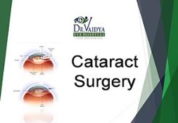 Cataract Surgery PowerPoint Presentation